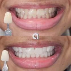 Teeth Whitening Training